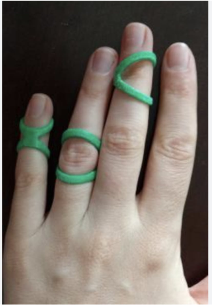 <p>tripod splint</p>