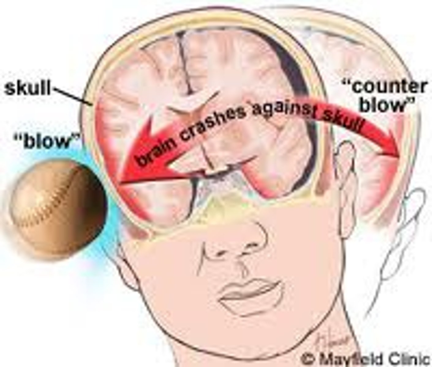 <p>violent shaking up or jarring of the brain</p><p>- bruising of brain</p><p>- damage to axonal fibers + white matter tracts</p><p>- blunt damage to gray matter</p>