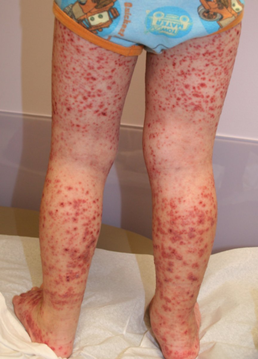 <p>1.) Purpura</p><p>2.) Arthritis</p><p>3.) Abdominal Pain</p>