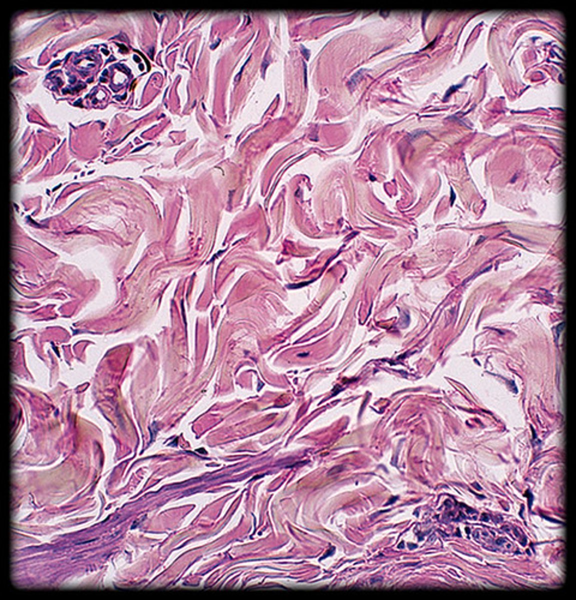 <p>- Thick bundles of collagen fibers arranged in random directions.</p><p>- Provides strength in multiple directions.</p><p>- Appears as densely packed, wavy collagen fibers under the microscope.</p><p>- Found in the dermis of the skin and fibrous capsules of organs.</p>