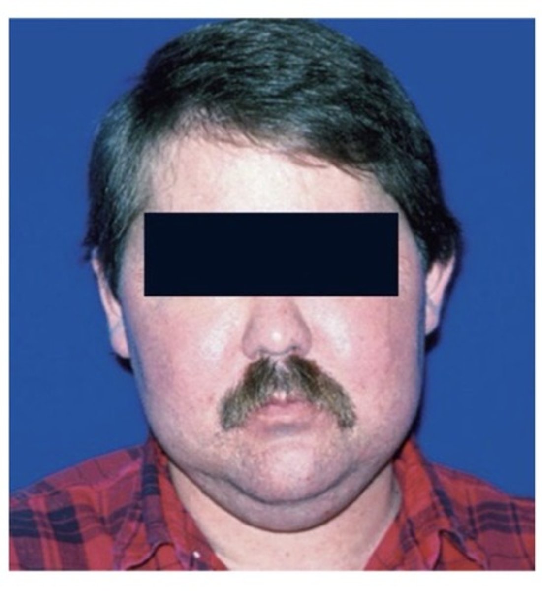 <p>The most common form of hyperadrenalism is due to glucocorticoid excess (endogenous or exogenous). This is also known as ——————— ———————: produces weight gain, round or moon-shaped faces, a "buffalo hump" on the upper back, abdominal striae, hypertension, hirsutism, and acne. Other findings may include: glucose intolerance (diabetes mellitus), heart failure, osteoporosis and bone fractures, and impaired healing.</p>