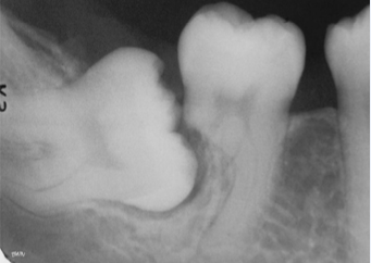 <p>Commonly occurs apically/ mid root and is associated with</p><ul><li><p>Cysts and tumors</p></li><li><p>ortho</p></li><li><p>excessive occlusal stress</p></li><li><p>reimplantation of avulsed tooth</p></li></ul><p></p>