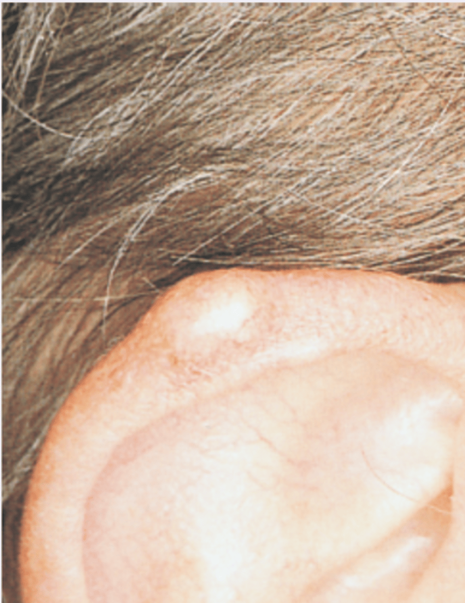 <p>dome shaped, fluid filled nodule</p>