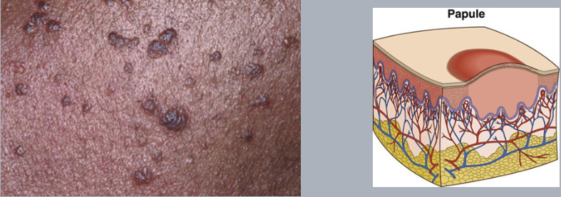 <p>papule</p>