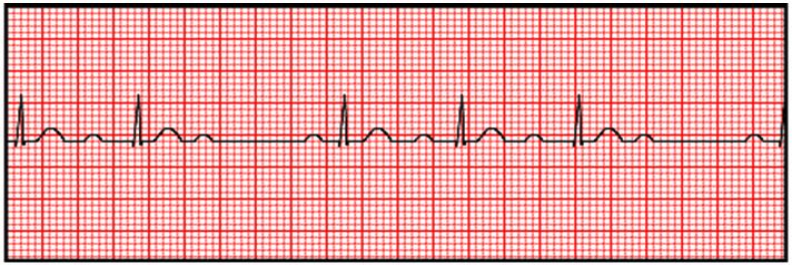 <p>progressive prolongation of PR interval until a dropped beat occurs</p>