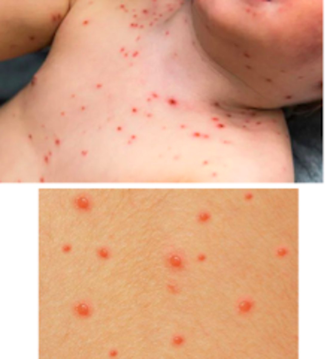 <p>Viral ID:</p><p>Subjective:</p><p>- Clinical manifestations develop within 15 days after exposure</p><p>- Prodrome: fever, malaise, pharyngitis, anorexia</p><p>- Pruritic rash: develops within 24 hours of prodrome, appears in successive crops over several days</p>