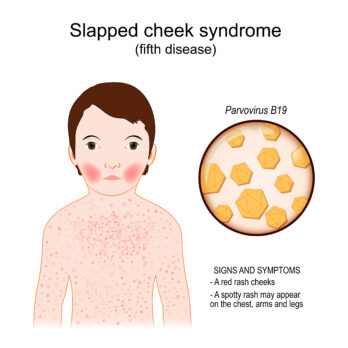 <p><strong>“slapped cheek” rash</strong></p><p>The <strong><em>immune response</em></strong><em> (immune complex deposition) during the </em><strong><em>non-infectious second phase</em></strong><em> causes the </em><strong><em>“slapped cheek” rash</em></strong><em>, not the virus itself.</em></p>