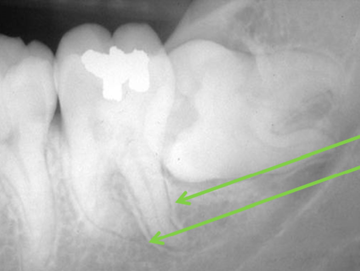 <p>thin compact bone that lines the alveolar socket</p>