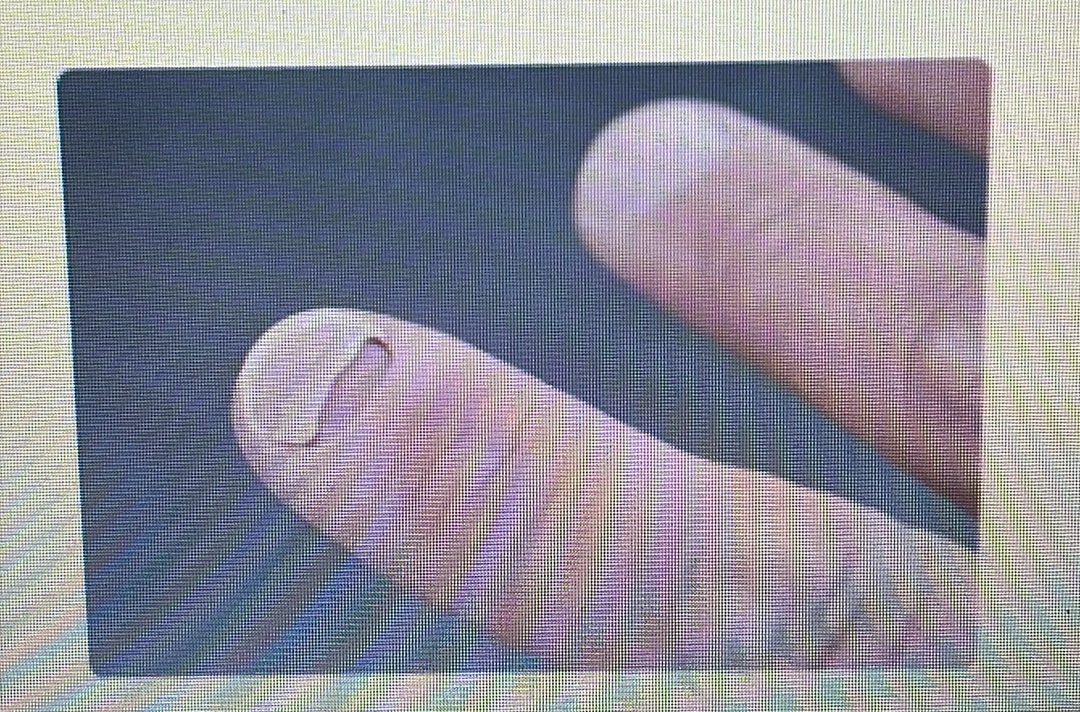 <p>NAIL DISORDER</p><p><span style="font-family: Calibri, sans-serif"><strong>Onycholysis</strong>: When your nail separates from your nail bed.</span></p>