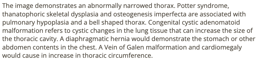 <p>d) thanatophoric skeletal dysplasia + osteogenesis imperfecta</p>