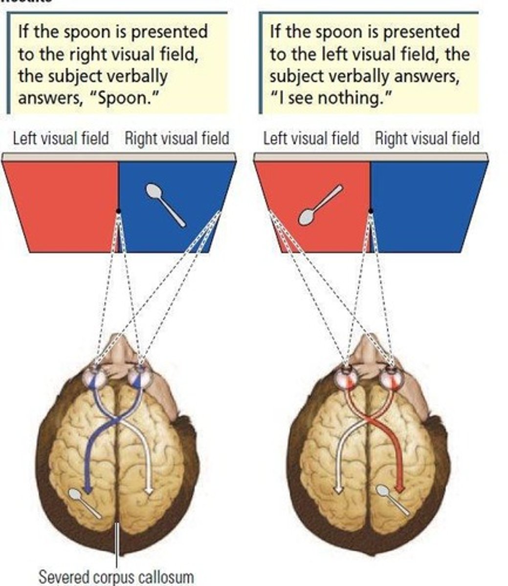 <p>A condition resulting from severing the corpus callosum, affecting communication between the brain's hemispheres.</p>