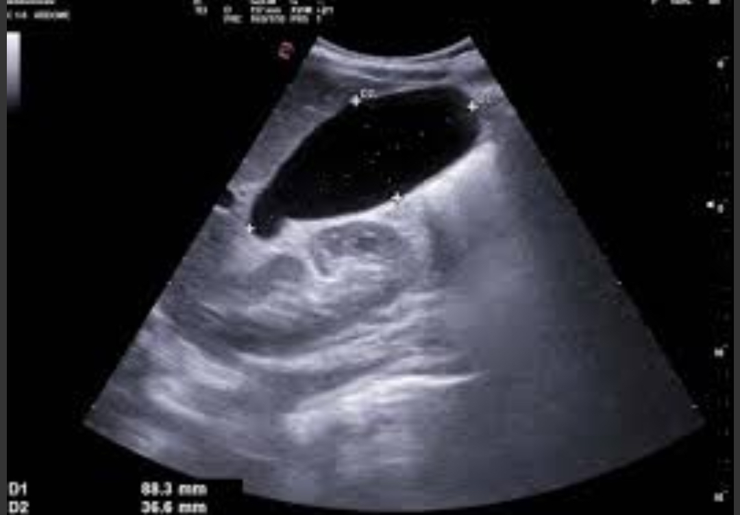 <p>G<span>B distension from prolonged cystic duct obstruction; filled with mucus </span></p><p><span>GB &gt;5 cm transverse, anechoic content, thin wall; often with obstructing stone in neck </span></p>
