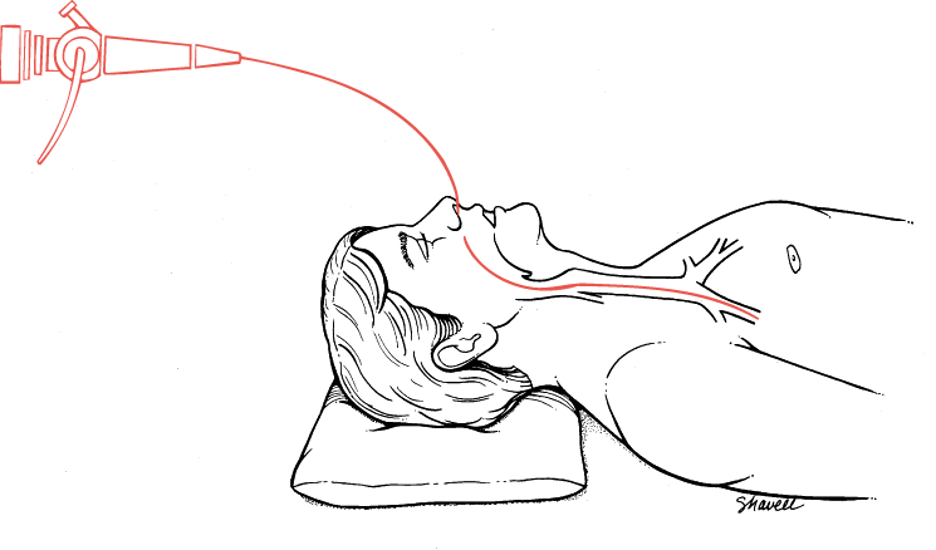 <p>direct visual examination of larynx, trachea &amp; bronchi with fiberoptic bronchoscope</p>