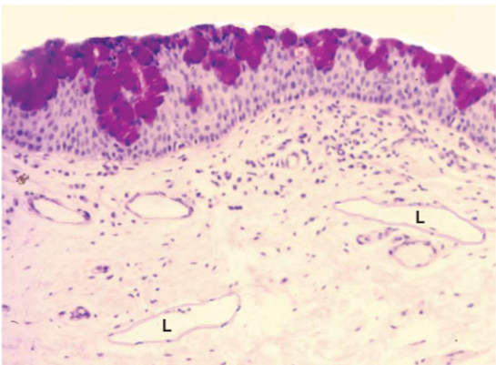 <ul><li><p>firmly adherent to tarsal plate (cant be moved)</p></li><li><p>stroma in palpebral conj has abundance of lymphoctyes and plasma cells that secret IgA</p></li><li><p>sometimes organize to form follicles</p></li><li><p>vascular structures in conj surrounded by mast cells that release granules containing histamine</p></li></ul><p></p>
