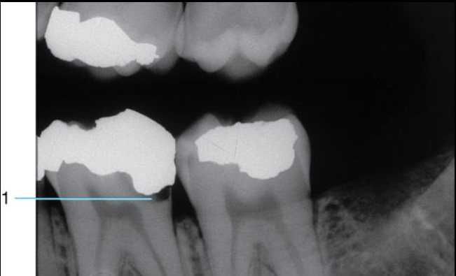 <p>AKA Secondary caries </p><ul><li><p>Evident adjacent to pre-existing restoration due to inadequate cavity prep, defective margins, or incomplete removal of caries prior to placing restoration</p></li><li><p>appears as radiolucent area just beneath restoration on radiograph. </p></li></ul><p></p>