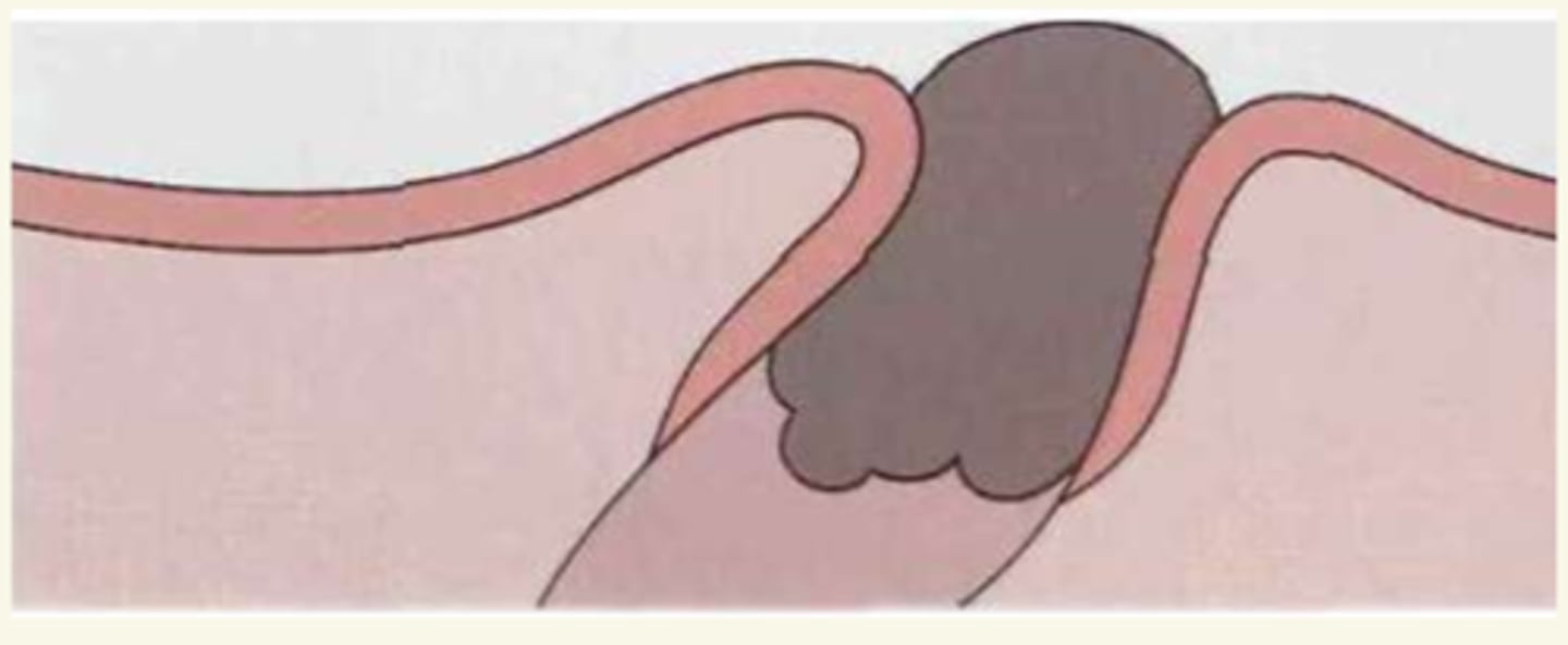 <p>¿lesión?</p><p>¿primaria o secundaria?</p>