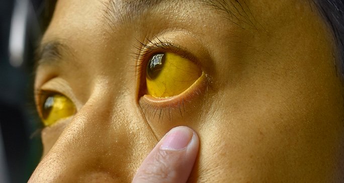 <p>jaundice</p>