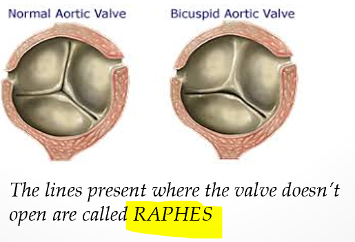 <p>lines present where the valve does not open (typically in larger leaflet) so when closed valve looks trileaflet </p>