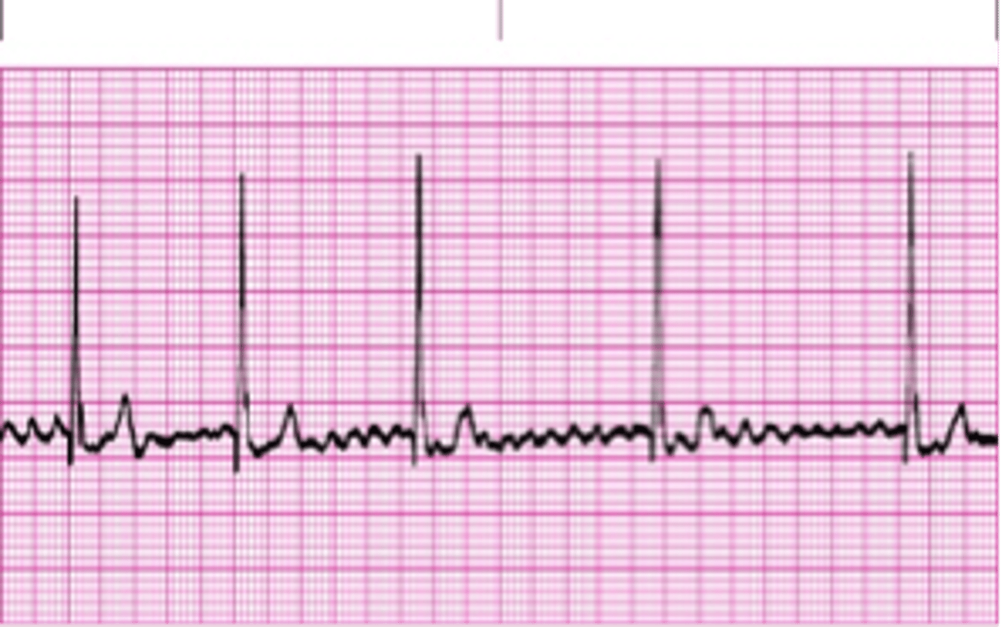 <p>-P waves absent </p><p>-narrow QRS</p><p>-P:QRS unrelated/ variable </p><p>-irregularly irregular </p><p>-chaotic atrial activity 500 bpm (loss of atrial kick) </p><p>-origin: multiple tiny reentrant circuits in atria </p><p>-most common sustained arrhythmia </p>