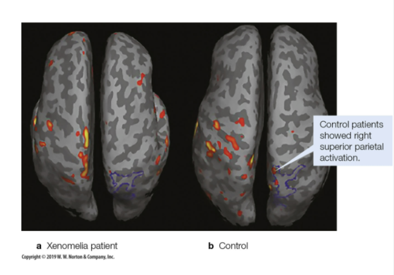 <p>Lifelong desire to amputate a limb</p><p>Usually a left limb, so right hemisphere is affected</p><p>Problem in superior parietal lobule (somatosensory, visual, and vestibular information converge)</p><ul><li><p>delays in information or limb info not being integrated properly</p></li></ul><p></p>