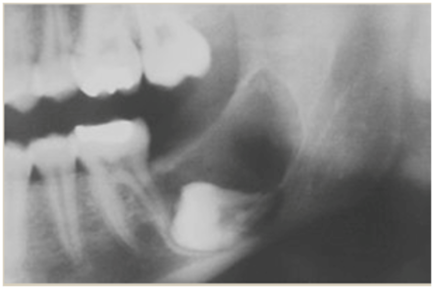 <p>benign non-encapsulated tumor</p>