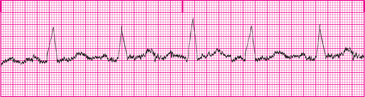 <p>Unwanted markings on the ECG caused by other electrical current sources. They appear as uniform small spikes resulting from rapid oscillation of waveform. The tracing looks like a caterpillar.&nbsp;</p>