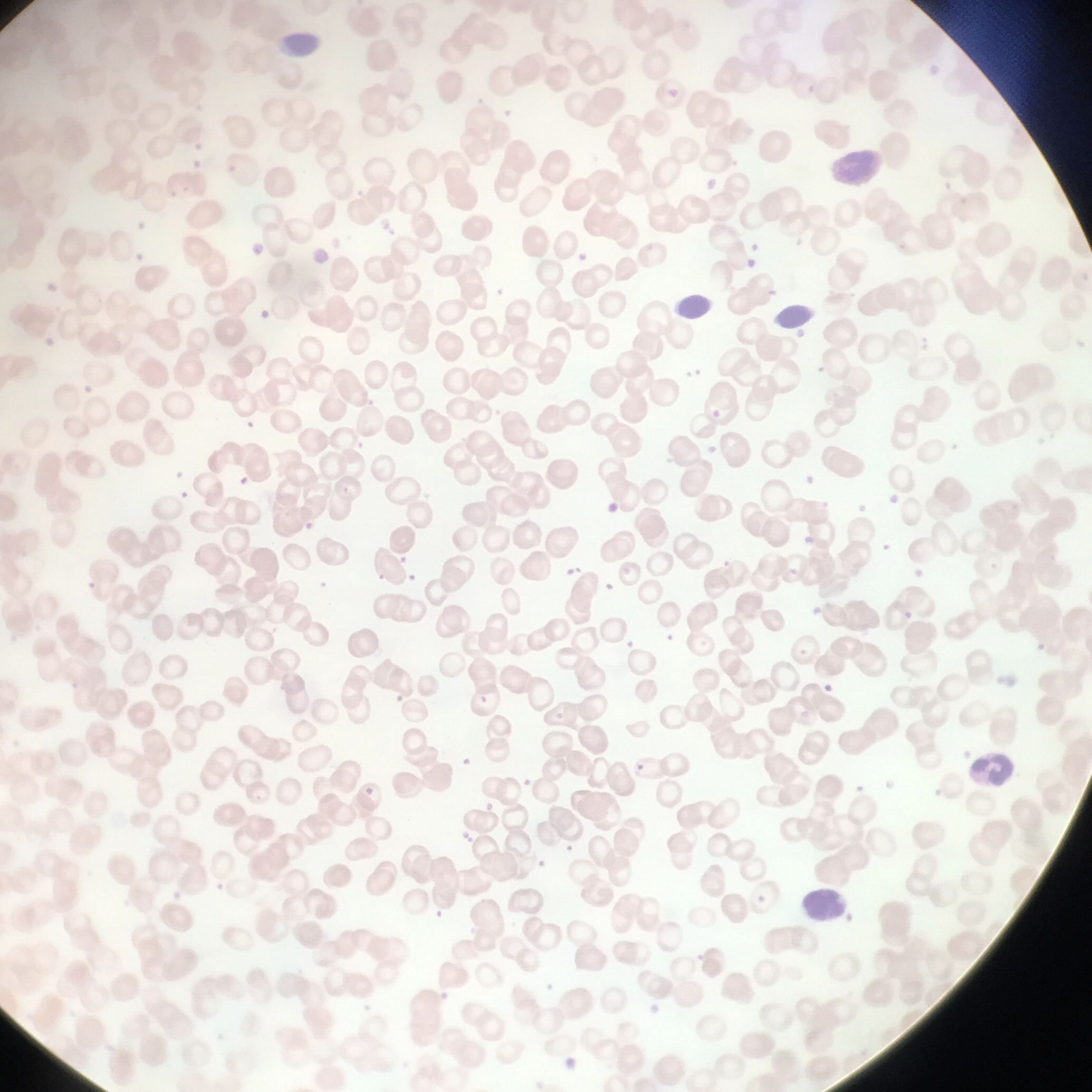 <ul><li><p>RBCs are macrocytic (larger than normal)</p></li><li><p>Unusual oval shape </p></li><li><p>Results from deficiency of vitamin B12</p></li><li><p>Lack of intrinsic factor needed for absorption of B12 </p></li></ul><p></p>