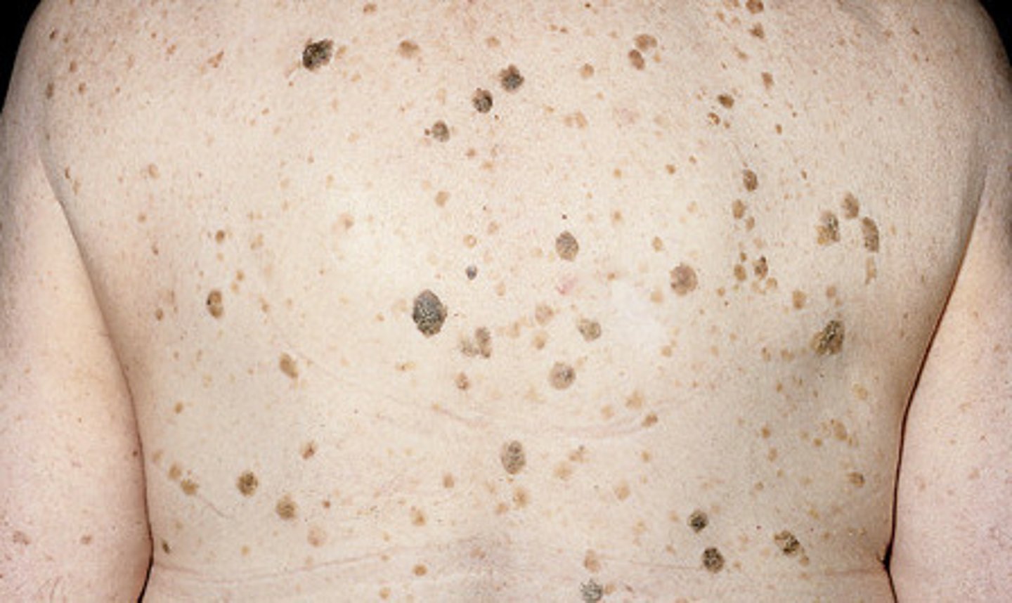 <p>raised, thickened areas of pigmentation that look crusted, scaly, and warty</p>