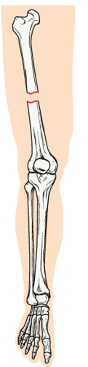 <p>One in which the bone is broken, but there is no open wound in the skin</p>