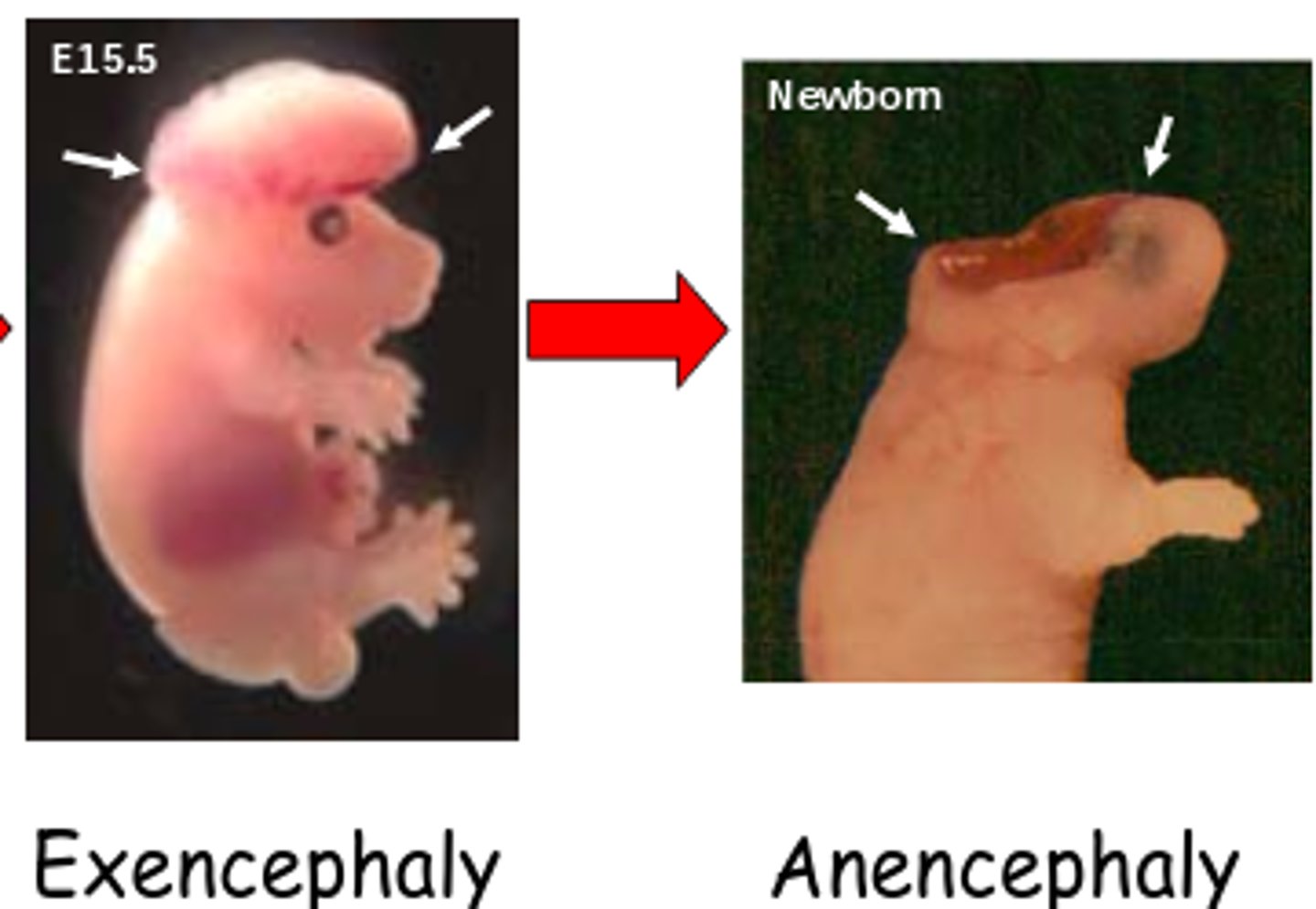 <p>Exencephaly</p>
