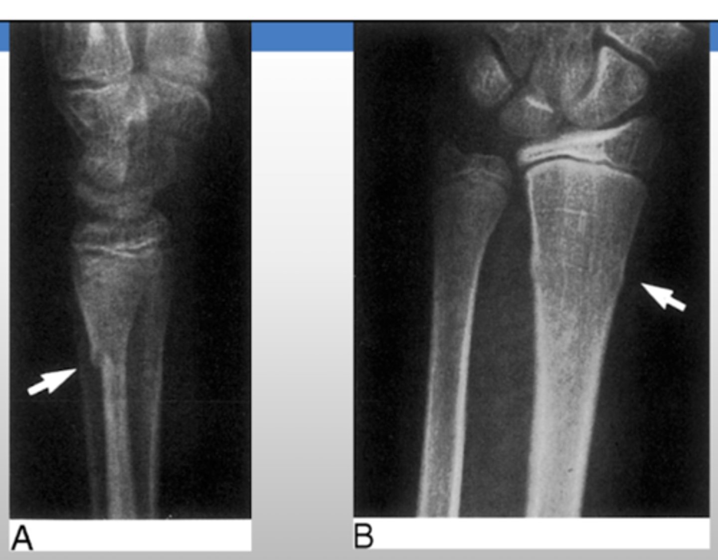 <p>torus fracture</p><p>- commonly seen in pediatrics as an incomplete fracture due to softer/pliable bones</p>