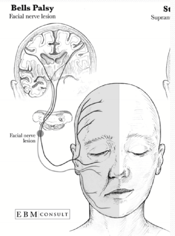 <p>Infranuclear lesion of CN VII </p>