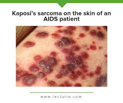 <p>PP: malignancy of vascular endothelial cells</p><p>E: <strong>AIDS-associated</strong><br>skin<br>mucosa<br>lymph nodes<br>GI tract</p><p>CM: reddish/blue-black macules/patches→spread+coalesce→nodules/plaques+edema</p><p>TX: surgical excision<br>radiation therapy<br>laser ablation<br>injected chemotherapy</p><p>P: slow progression<br>deaths due to other causes<br>AIDS→intercurrent/secondary infection→death</p>