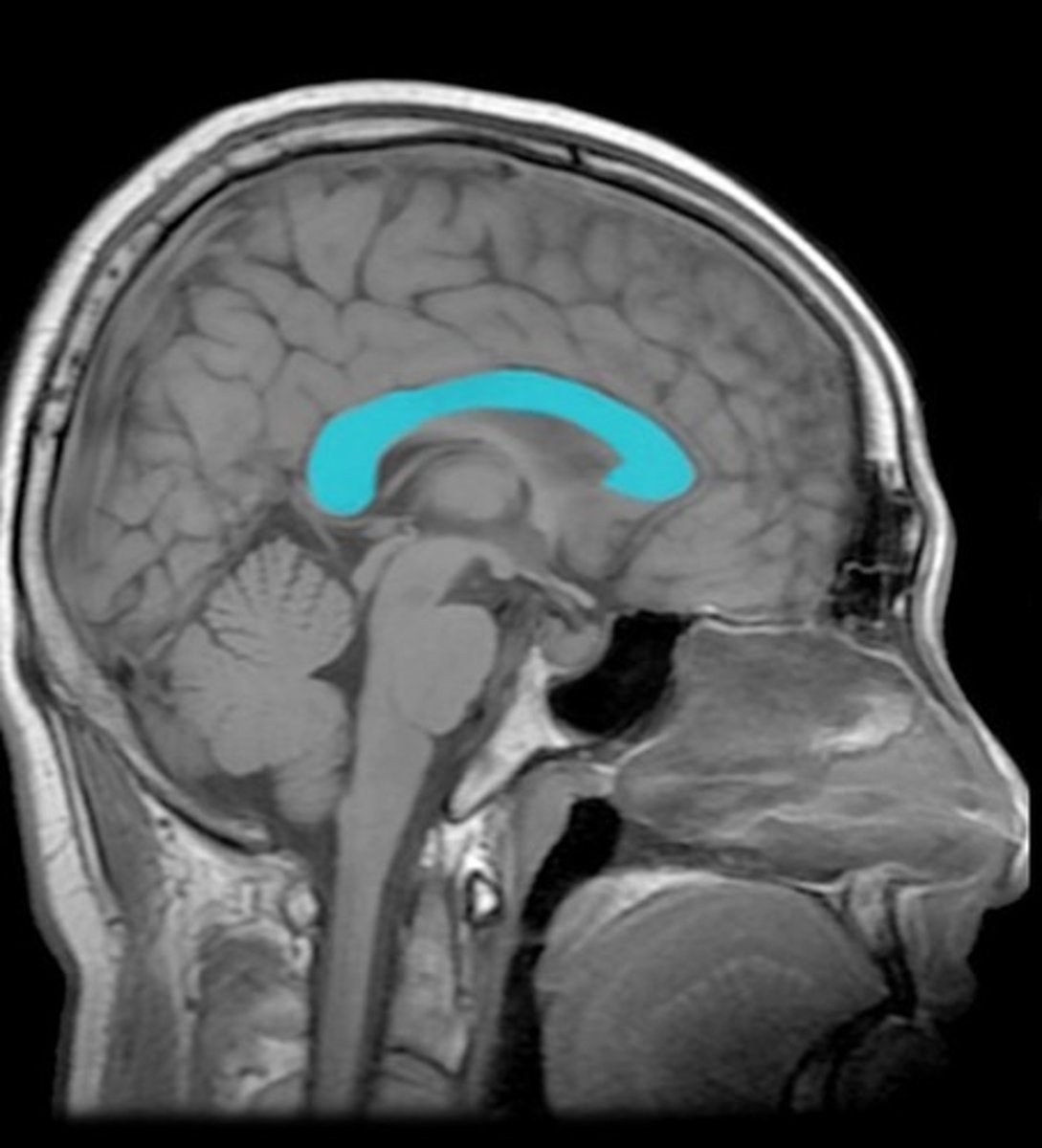 <p>largest cavities of ventricular system; opens through interventricular foramen into 3rd ventricle</p>
