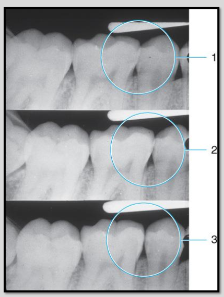 <p>Correcting horizontal angulation for open contacts.</p>
