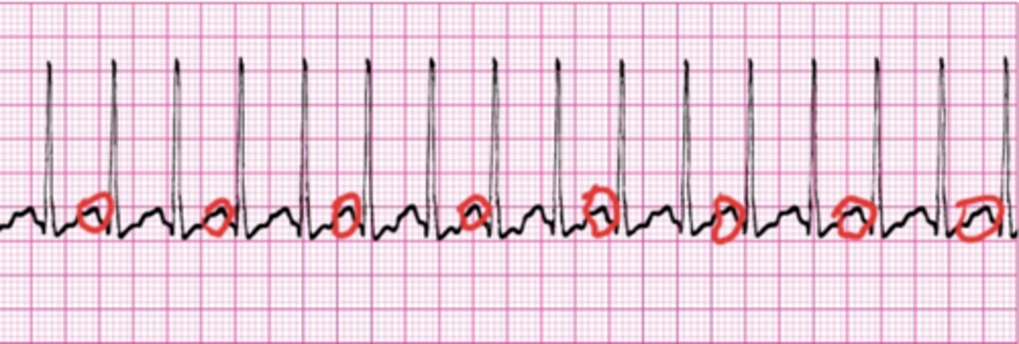 <p>Atrial Tachycardia is caused when abnormal electrical signals inersect with signals coming from the SA node.</p><p>It can prevent the heart from filling normally and refuse the overall blood flow out of the heart due to rapid rate.</p><p>'Teeny-tiny' P's noted, FAST rate, narrow complexes and REGULAR</p>