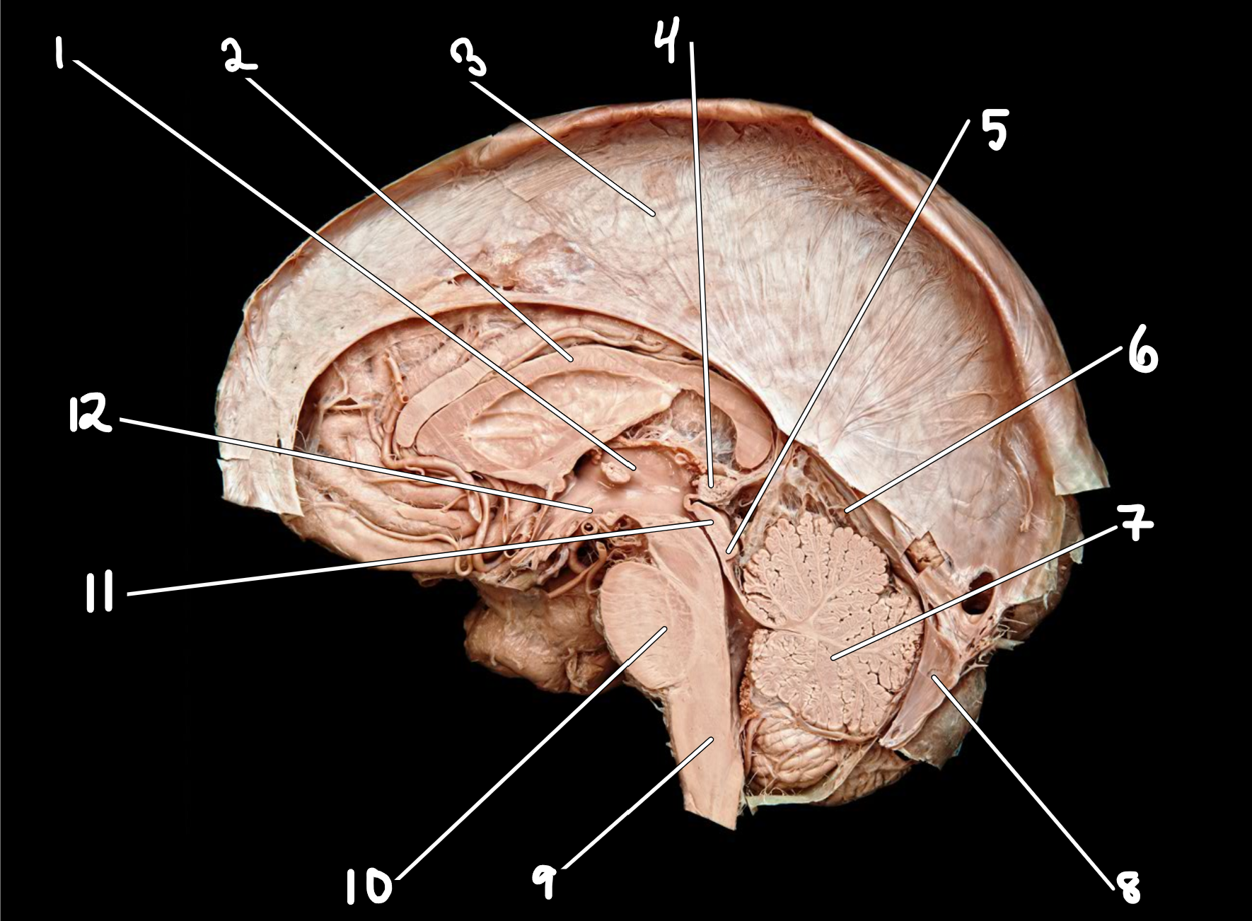 <p>Midsagittal brain with dura mater</p>