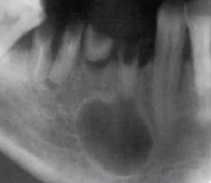 <p>What other dental anomaly has Similar Radiographic Features compared to Radicular Cysts?</p>