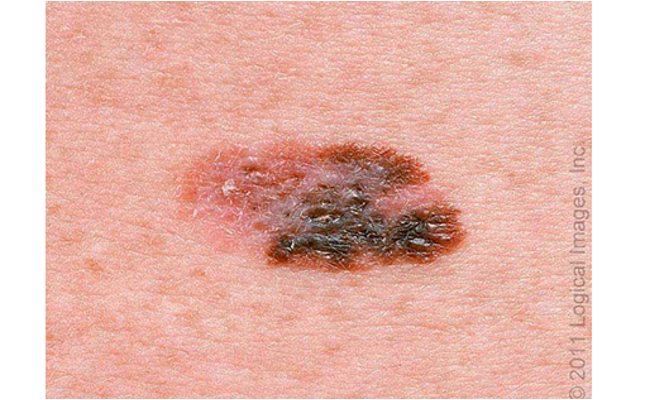 <ul><li><p><strong>MC histological subtype of melanoma</strong></p></li><li><p>variably pigmented macule or thin plaque w/ irregular border ranging few-several cm</p></li><li><p>multiple shades of red, blue. black, gray, white</p></li><li><p>traditionally stays in horizontal growth phase</p></li><li><p>dermoscopy inc dx accuracy &gt;50%</p></li><li><p>located anywhere on body</p></li><li><p>histology- asymmetric, poorly circumscribed, lack cellular maturation</p></li></ul><p></p>