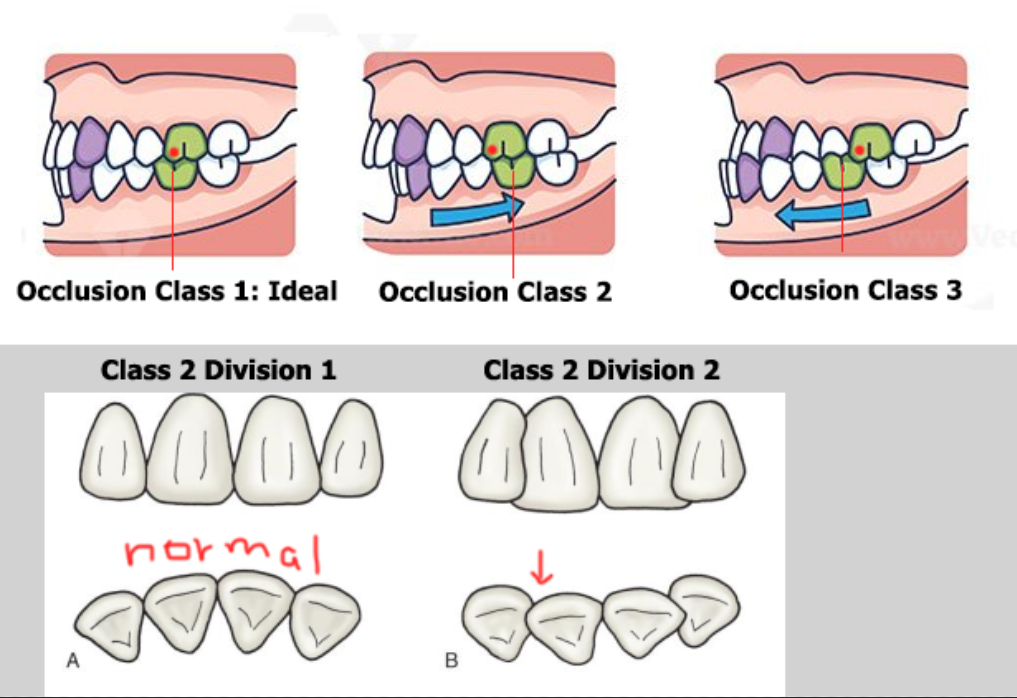 <p><strong>Class I (Normal / Neutroclusion)</strong></p><ul><li><p>Upper 1st molar’s mesiobuccal cusp fits into lower 1st molar’s mesiobuccal groove.</p></li><li><p>Bite is normal, but crowding/spacing may exist.</p></li></ul><p><strong>Class II (Distocclusion)</strong></p><ul><li><p>buccal groove of mand 1M is posterior to MB cusp of max 1M </p></li><li><p>Upper teeth stick out (overjet).</p></li><li><p><strong>Has 2 divisions:</strong></p><ul><li><p><strong>Div 1:</strong> Class 2 1M but max central incisors are normal </p></li><li><p><strong>Div 2:</strong> Class 2 1M and max central incosrs are retruded and inclined lingually </p></li></ul></li></ul><p><strong>Class III (Mesiocclusion)</strong></p><ul><li><p>buccal groove of mand 1M is more anterior to the MB cusp of max 1M </p></li><li><p>Underbite appearance.</p></li></ul><p></p>
