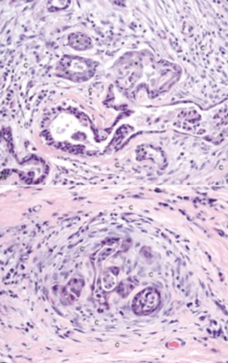 <p>What type of response is produced by this carcinoma?</p>