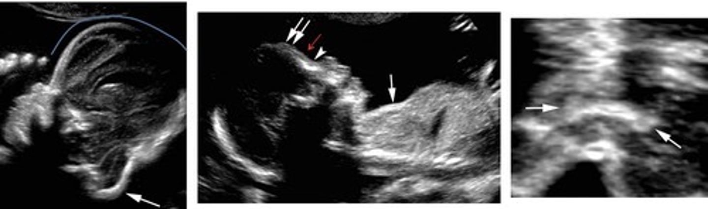 <p>Most common form of Thanatophoric Dysplasia</p><p>Short bowed femurs</p><p>Flat vertebral bodies</p><p>Frontal bossing</p>