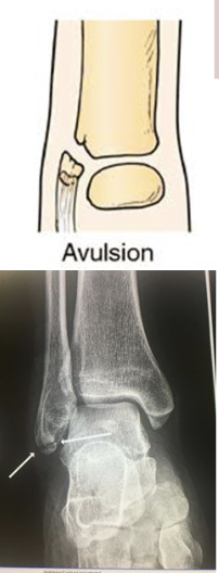 <p>Fragment of bone is pulled away an attached tendon or ligament</p>