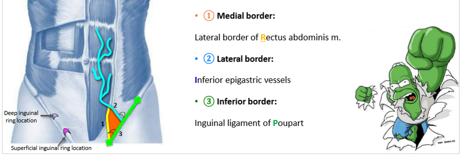 <p>RIP</p><p>Direct inguinal hernia’s RIP through the triangle</p>