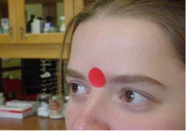 <p>Which frontal bone marking is this? (1)</p>