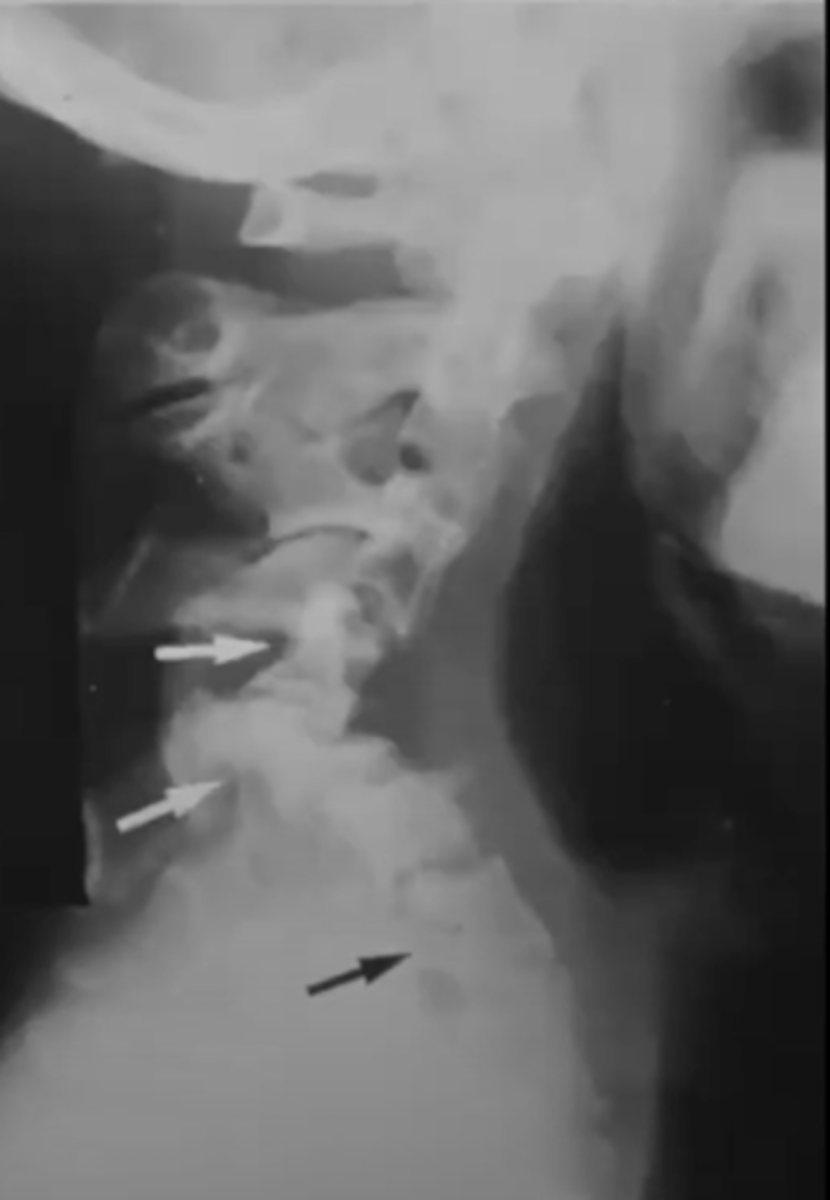 <p>What is this?</p><p>Ex. Pt has Fibroma Molluscum, Cafe Au Lait spots + Coast of California, Kyphoscoliosis</p>