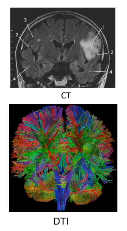 <ul><li><p>CT— computer tomography avec rayon X</p></li><li><p>MRI — magnetic resonance imaging avec champ magnétique</p></li><li><p>DTI — Diffusion tensor magnetic resonance imaging, visualisation des régions cérébrale métaboliquement active</p></li></ul><p></p>