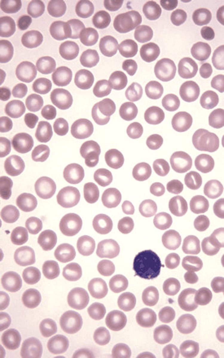 <p>presence of red blood cells of unequal size</p>
