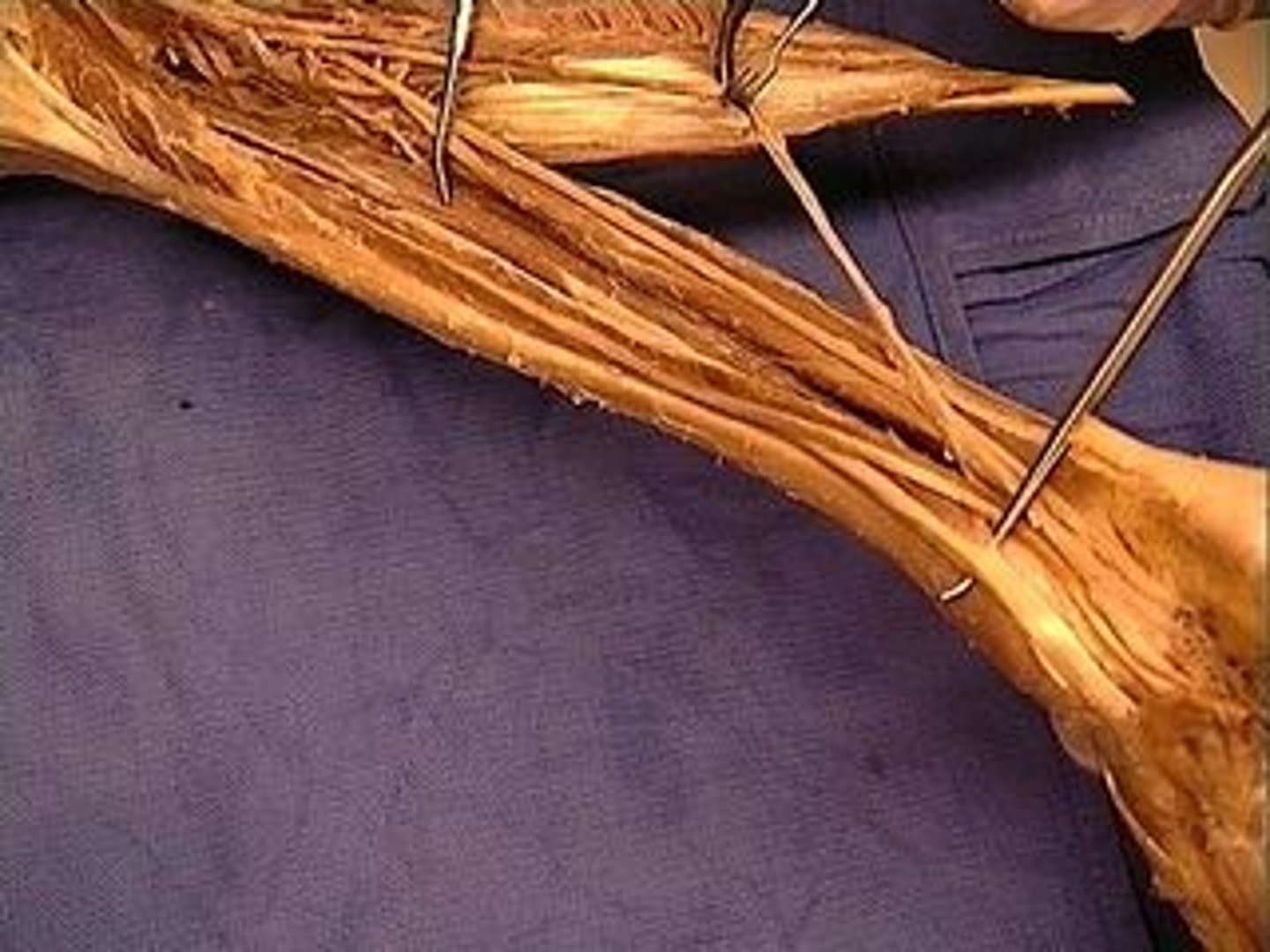 <p>Is a deep muscle that lies deep to the soleus; Inverts foot; may assist in strong plantar flexion or control pronation of foot during walking</p>