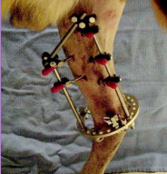 <ul><li><p><span style="background-color: transparent;"><strong><span>What: </span></strong></span></p><ul><li><p><span style="background-color: transparent;"><strong><span>Pins</span></strong><span>: Engage bone, provide stabilization</span></span></p></li><li><p><span style="background-color: transparent;"><strong><span>Clamps</span></strong><span>: Secure pins to connecting bar.</span></span></p></li><li><p><span style="background-color: transparent;"><strong><span>Connecting bar</span></strong><span>: Links clamps and pins.</span></span></p></li></ul></li><li><p><span style="background-color: transparent;"><strong><span>Types: </span></strong></span></p><ul><li><p><span style="background-color: transparent;"><strong><span>Linear: </span></strong><span>Frame strength ↑ with complexity</span></span></p><ul><li><p><span style="background-color: transparent;"><strong><span>Type IA:</span></strong><span> </span><u><span>Unilateral</span></u><span>, uniplanar</span></span></p></li><li><p><span style="background-color: transparent;"><strong><span>Type IB: </span></strong><span>Unilateral, biplanar</span></span></p></li><li><p><span style="background-color: transparent;"><strong><span>Type II:</span></strong><span> </span><u><span>Bilateral</span></u><span>, uniplanar</span></span></p></li><li><p><span style="background-color: transparent;"><strong><span>Type III: </span></strong><span>Bilateral, biplanar</span></span></p></li></ul></li><li><p><span style="background-color: transparent;"><strong><span>Hybrid ring </span></strong></span></p><ul><li><p><span style="background-color: transparent;"><strong><span>Why:</span></strong><span> fractures with small </span><u><span>bone fragments</span></u></span></p></li><li><p><span style="background-color: transparent;"><strong><span>What: </span></strong><span>Combo half pins + ring with small fixation wires</span></span></p></li></ul></li><li><p><span style="background-color: transparent;"><strong><span>Circular</span></strong></span></p><ul><li><p><span style="background-color: transparent;"><strong><span>What: </span></strong><span>Kirschner wires + rings + connecting bars</span></span></p></li><li><p><span style="background-color: transparent;"><strong><span>Why</span></strong><span>: </span><u><span>comminuted fractures, angular limb</span></u><span> deformities</span></span></p></li></ul></li></ul></li></ul><p></p>